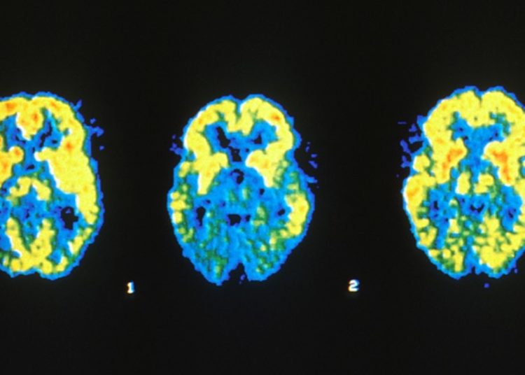 Intensive blood pressure control may decrease risk of mild cognitive impairment