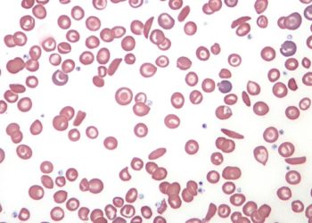 The REACH trial: hydroxyurea safe and effective for sickle cell anemia in African children