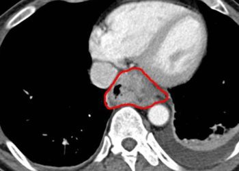 Hybrid minimally invasive esophagectomy associated with lower complication rates compared to open esophagectomy