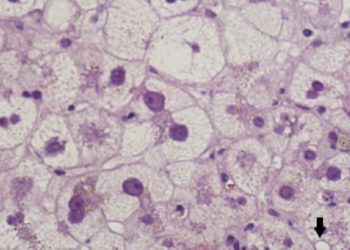 Quick Take: Histopathologic Predictors of Survival and Recurrence in Resected Ampullary Adenocarcinoma: International Multicenter Cohort Study