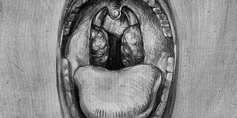 tonsillectomy