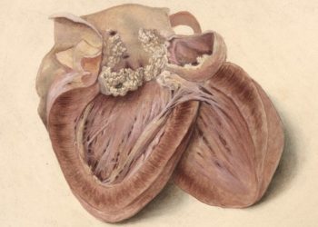 The POET trial: oral antibiotics in stable endocarditis patients noninferior to intravenous treatment