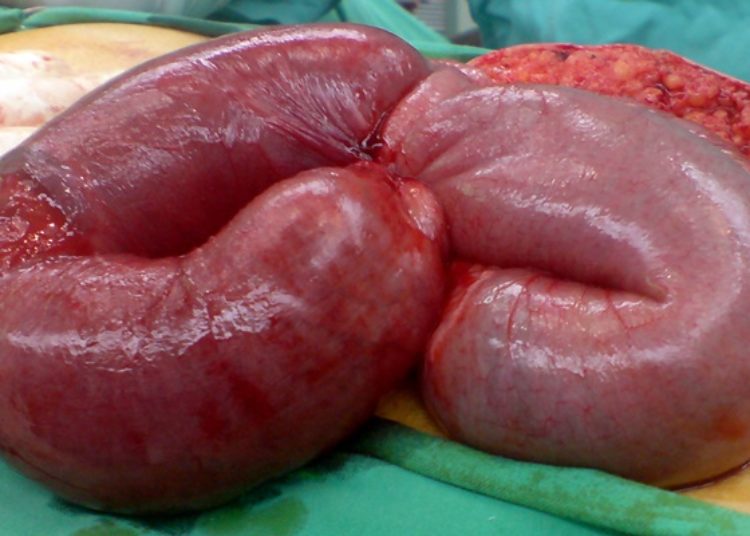 Quick Take: Association of Surgical Intervention for Adhesive Small-Bowel Obstruction With the Risk of Recurrence