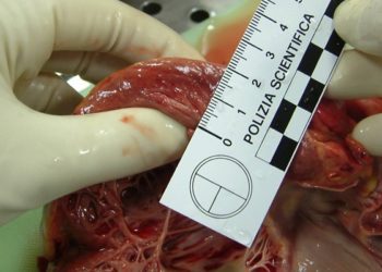 MYBPC3 haploinsufficiency results in hypertrophic cardiomyopathy by altering myosin head configurations [PreClinical]
