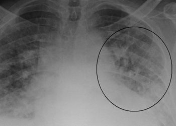 The PIONEER-HF Trial: Sacubitril-valsartan linked to superior outcomes in acute decompensated heart failure