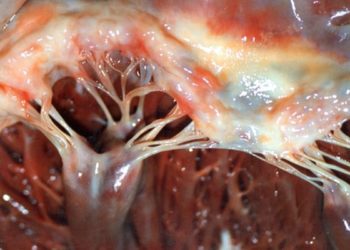 Quick Take: Left ventricular mechanical dispersion predicts arrhythmic risk in mitral valve prolapse