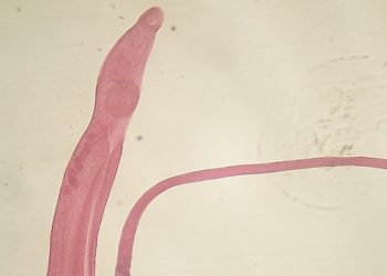 Students infected by Schistosoma shed light on cause of Katayama syndrome