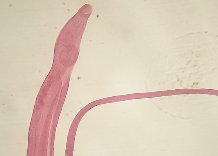 Students infected by Schistosoma shed light on cause of Katayama syndrome