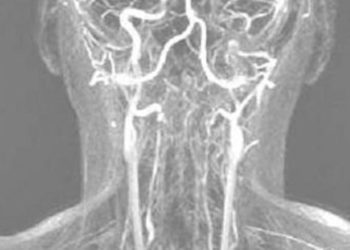 Quick Take: Antiplatelet Therapy vs Anticoagulation Therapy in Cervical Artery Dissection: The Cervical Artery Dissection in Stroke Study (CADISS) Randomized Clinical Trial Final Results