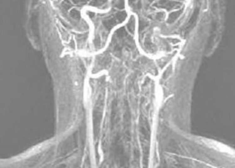 Quick Take: Antiplatelet Therapy vs Anticoagulation Therapy in Cervical Artery Dissection: The Cervical Artery Dissection in Stroke Study (CADISS) Randomized Clinical Trial Final Results