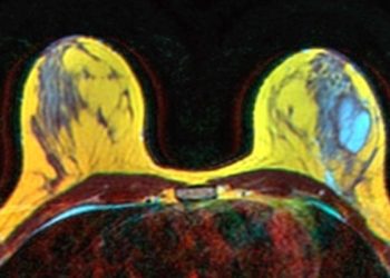 Quick Take: Diffusion-weighted Imaging of Invasive Breast Cancer: Relationship to Distant Metastasis–free Survival