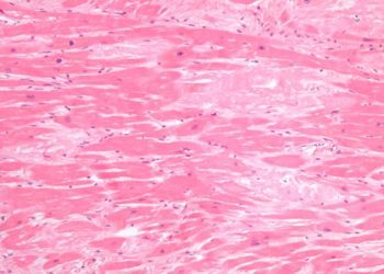 Patisiran therapy reduces ventricular myocardial strain in hereditary transthyretin amyloidosis