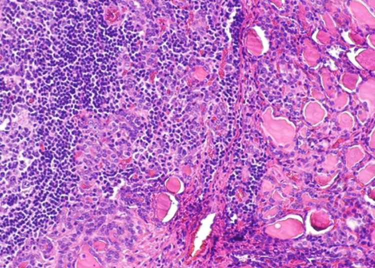 Thyroidectomy more effective than medication for Hashimoto disease with persisting symptoms