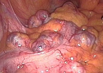 Quick Take: Long-term outcome of surgery versus conservative management for recurrent and ongoing complaints after an episode of diverticulitis