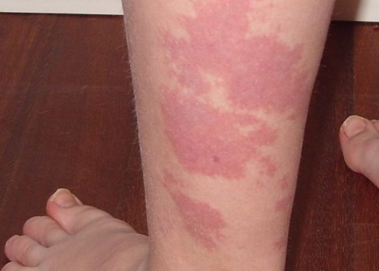 Quick Take: Pulsed Dye Laser Treatment of Port-Wine Stains in Infancy Without the Need for General Anesthesia