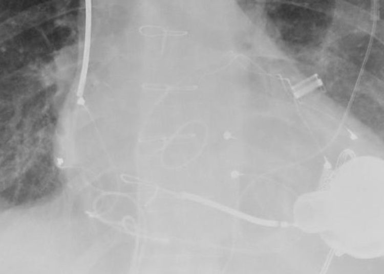 Mesenchymal precursor cell transplant did not improve weaning from device support in LVAD patients