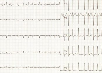 Rivaroxaban likely reduces risk of recurrent stroke in specific subgroup of patients with embolic stroke of undetermined source