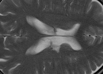 Quick Take: Functional Outcome of Intravenous Thrombolysis in Patients With Lacunar Infarcts in the WAKE-UP Trial