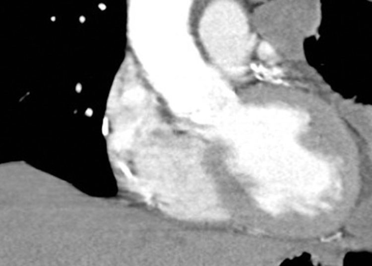 Quick Take: Prophylactic Irradiation of Tracts in Patients With Malignant Pleural Mesothelioma: An Open-Label, Multicenter, Phase III Randomized Trial