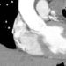 Quick Take: Prophylactic Irradiation of Tracts in Patients With Malignant Pleural Mesothelioma: An Open-Label, Multicenter, Phase III Randomized Trial