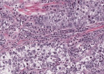 Quick Take: Pembrolizumab Versus Chemotherapy for Previously Untreated, PD-L1-Expressing, Locally Advanced or Metastatic Non-Small-Cell Lung Cancer (KEYNOTE-042)