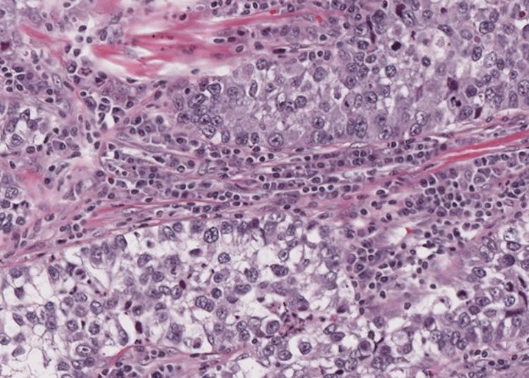 Quick Take: Pembrolizumab Versus Chemotherapy for Previously Untreated, PD-L1-Expressing, Locally Advanced or Metastatic Non-Small-Cell Lung Cancer (KEYNOTE-042)