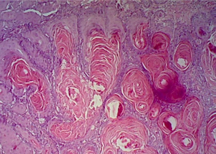 Doxepin or diphenhydramine-lidocaine-antacid mouthwash modestly reduces radiation-related mucositis pain