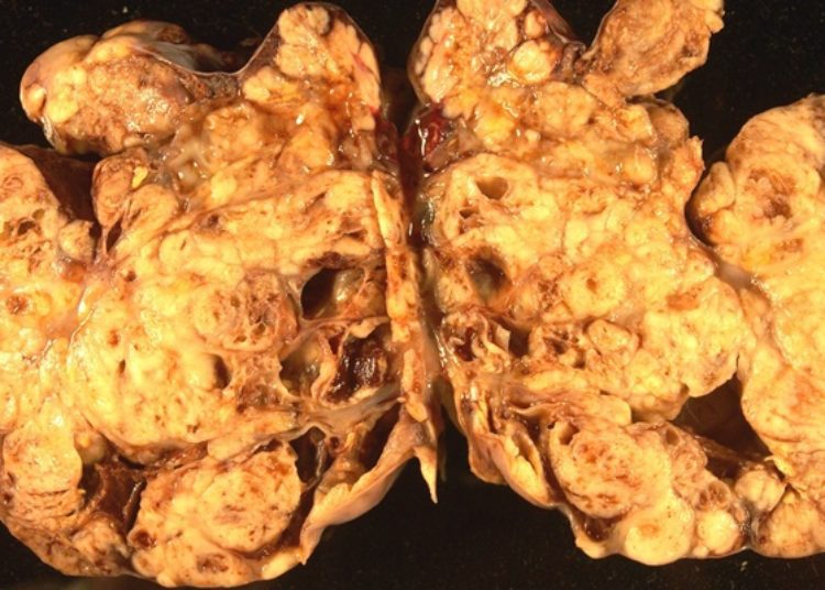 Quick Take: Randomized Trial of Intravenous Versus Intraperitoneal Chemotherapy Plus Bevacizumab in Advanced Ovarian Carcinoma