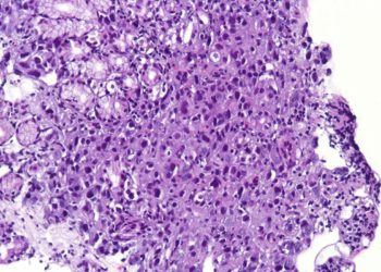 Quick Take: Combined Surgery and Extensive Intraoperative Peritoneal Lavage vs Surgery Alone for Treatment of Locally Advanced Gastric Cancer: The SEIPLUS Randomized Clinical Tria