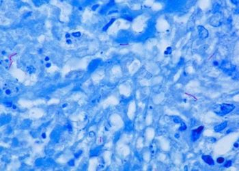 Quick Take: Discovery and validation of a prognostic proteomic signature for tuberculosis progression
