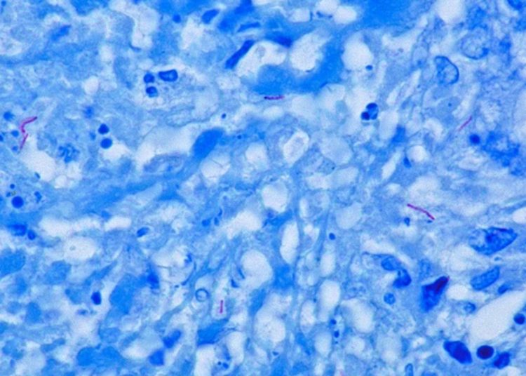 Quick Take: Discovery and validation of a prognostic proteomic signature for tuberculosis progression