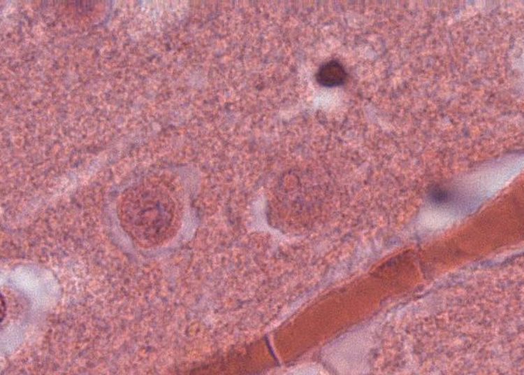 Quick Take: Association of Blood and Cerebrospinal Fluid Tau Level and Other Biomarkers With Survival Time in Sporadic Creutzfeldt-Jakob Disease