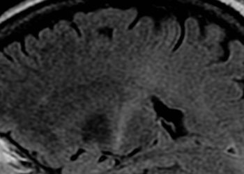 Quick Take: Amyotrophic Lateral Sclerosis versus Multifocal Motor Neuropathy: Utility of MR Neurography