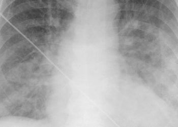 Quick Take: Association of Rivaroxaban With Thromboembolic Events in Patients With Heart Failure, Coronary Disease, and Sinus Rhythm