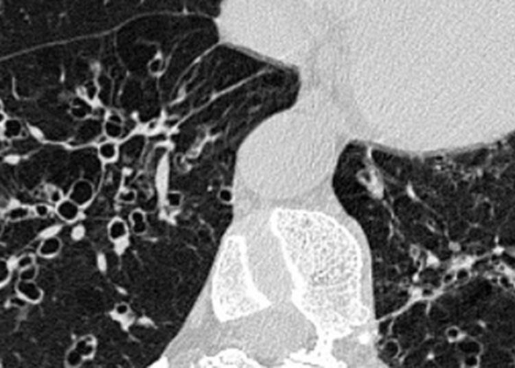 Quick Take: Liver Fibrosis and Metabolic Alterations in Adults with Alpha1 Antitrypsin Deficiency Caused by the Pi*ZZ Mutation