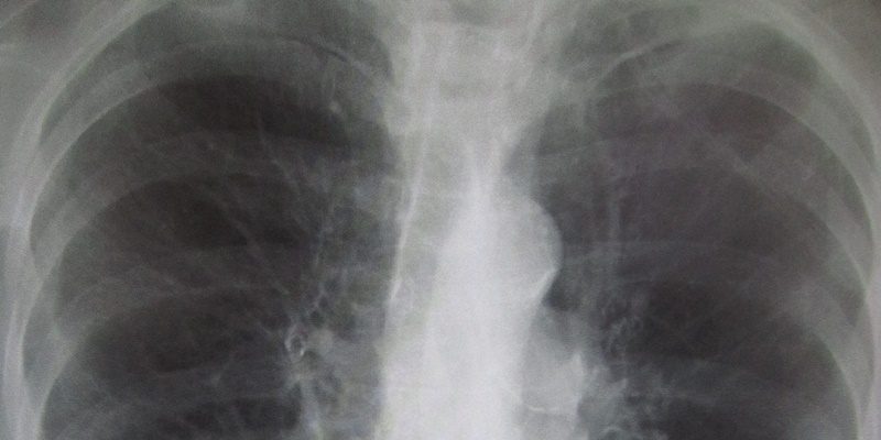 Early asthma and COPD intervention decreases healthcare utilization Early asthma and COPD intervention decreases healthcare utilization