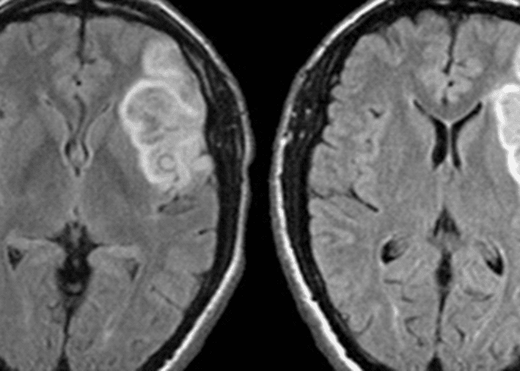 The EXTEND trial: neurological deficits decreased with thrombolysis up to 9 hours after stroke onset