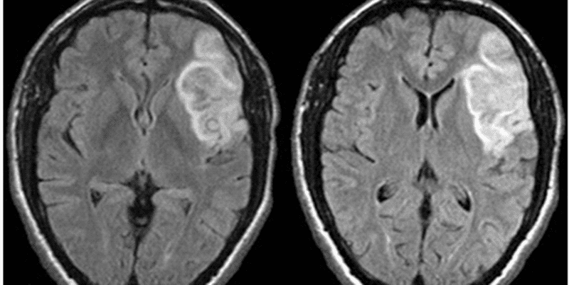 FLAIR_MRI_of_cerebral_infarction