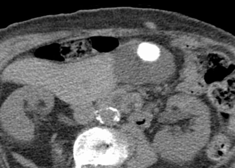 Quick Take: Restrictive strategy versus usual care for cholecystectomy in patients with gallstones and abdominal pain (SECURE)