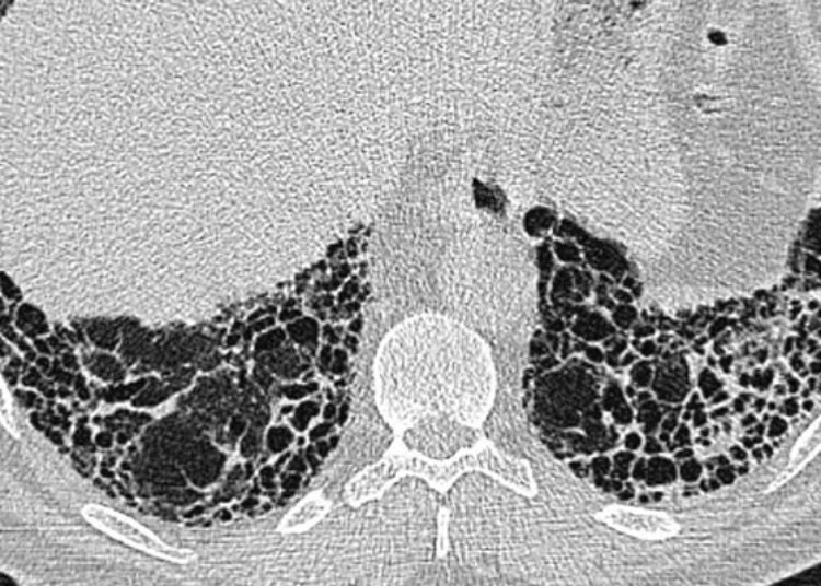 The SENSCIS trial: nintedanib slows declines in FVC in patients with interstitial lung disease caused by systemic sclerosis