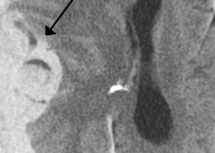 Use of aspirin for primary prevention linked to increased risk of intracranial hemorrhage