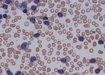 The CLL14 trial: longer progression-free survival for CLL patients with coexisting conditions treated with venetoclax