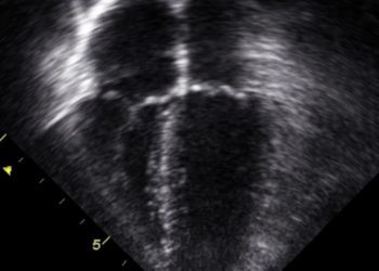 Lisinopril and carvedilol reduce cardiotoxicity in breast cancer patients receiving trastuzumab and anthracyclines