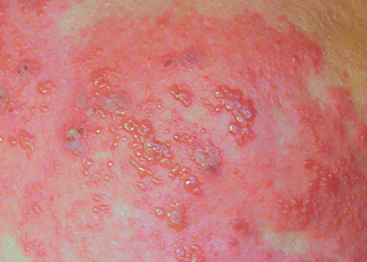 Decline in pediatric herpes zoster associated with varicella vaccine