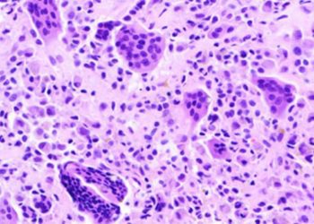 Quick Take: Pexidartinib versus placebo for advanced tenosynovial giant cell tumour (ENLIVEN)
