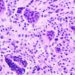 Quick Take: Pexidartinib versus placebo for advanced tenosynovial giant cell tumour (ENLIVEN)