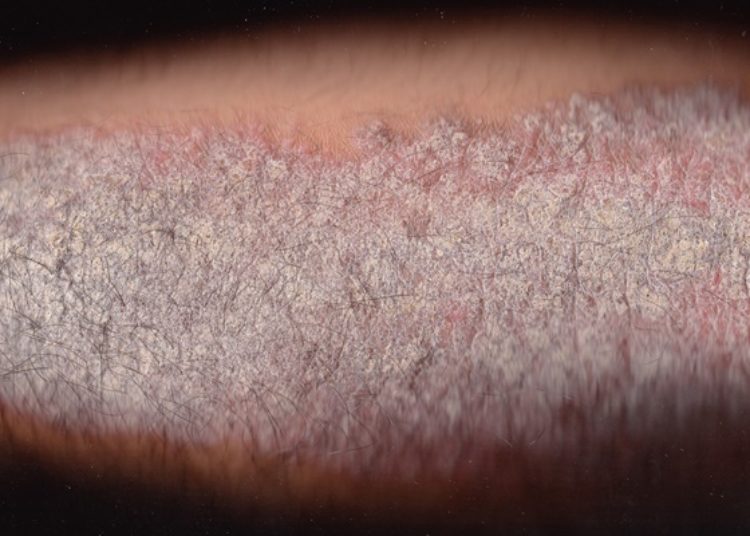 Quick Take: Risankizumab compared with adalimumab in patients with moderate-to-severe plaque psoriasis (IMMvent)