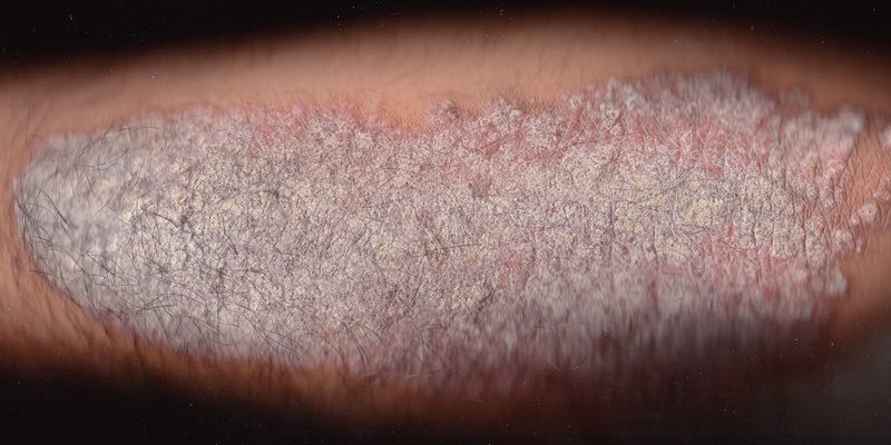 Plaque_Type_Psoriasis
