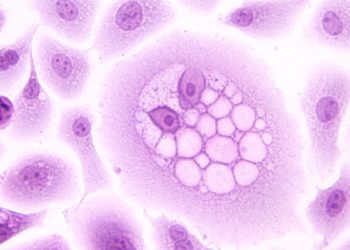 Quick Take: T-Cell Receptor Gene Therapy for Human Papillomavirus–Associated Epithelial Cancers: A First-in-Human, Phase I/II Study