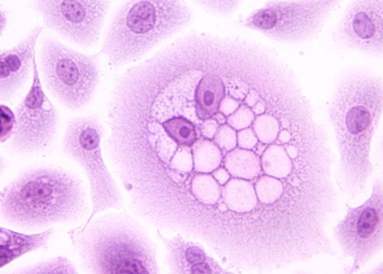 Quick Take: T-Cell Receptor Gene Therapy for Human Papillomavirus–Associated Epithelial Cancers: A First-in-Human, Phase I/II Study